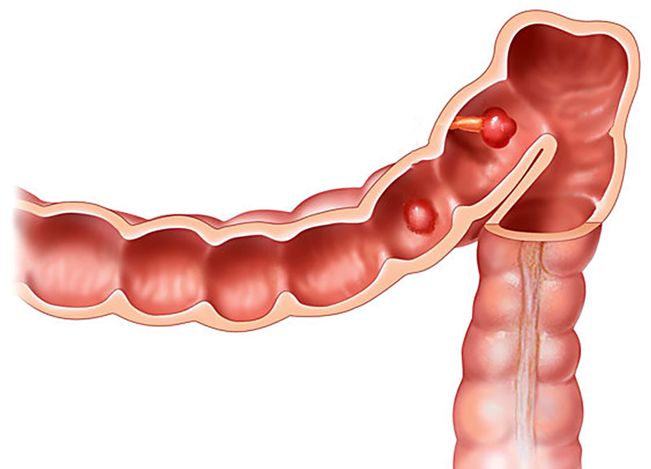 NCI Colon